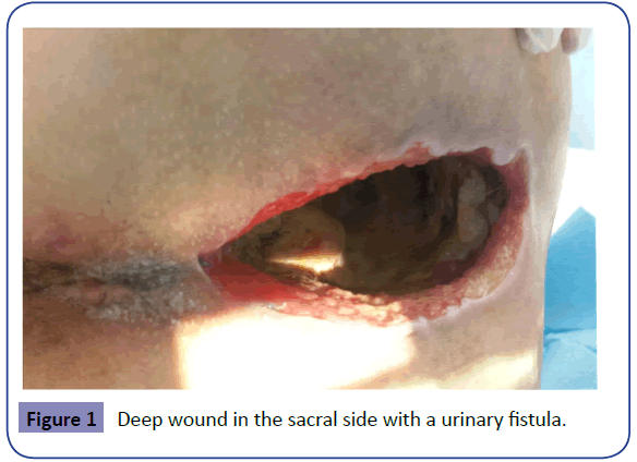 Colorectal-Cancer-Deep-wound-sacral
