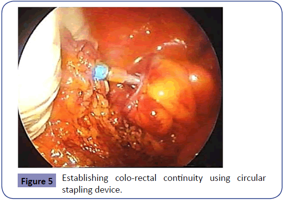 Colorectal-Cancer-Establishing-colo-rectal