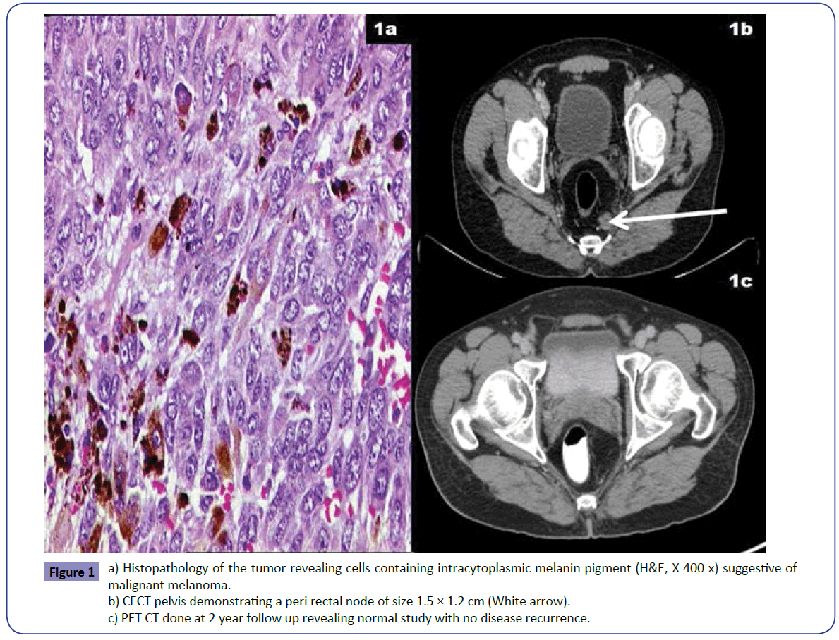 Colorectal-Cancer-Histopathology-tumor-revealing