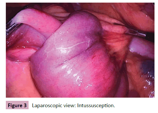 Colorectal-Cancer-Intussusception