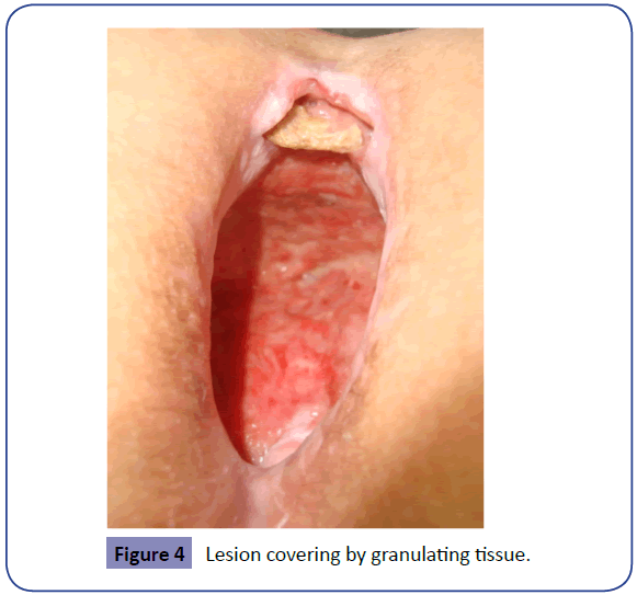 Colorectal-Cancer-Lesion-covering-granulating