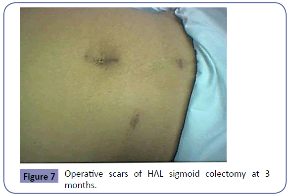 Colorectal-Cancer-Operative-scars-sigmoid