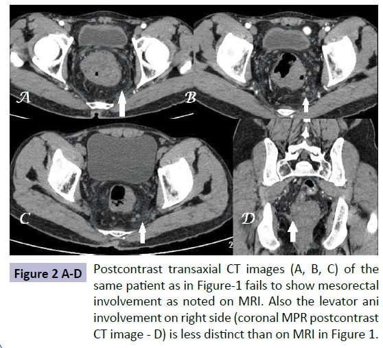 rectal cancer on ct scan