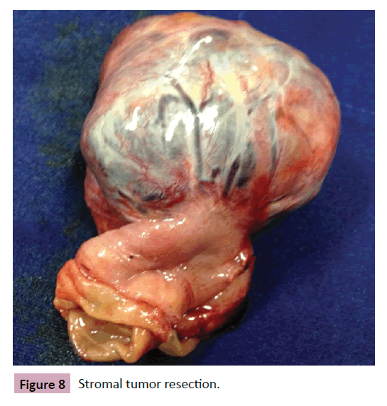 Colorectal-Cancer-Stromal-tumor