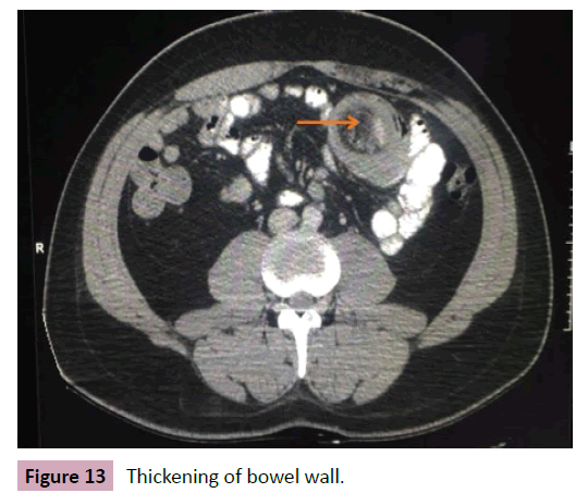 Colorectal-Cancer-Thickening-bowel