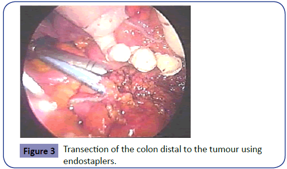 Colorectal-Cancer-Transection-colon-tumour