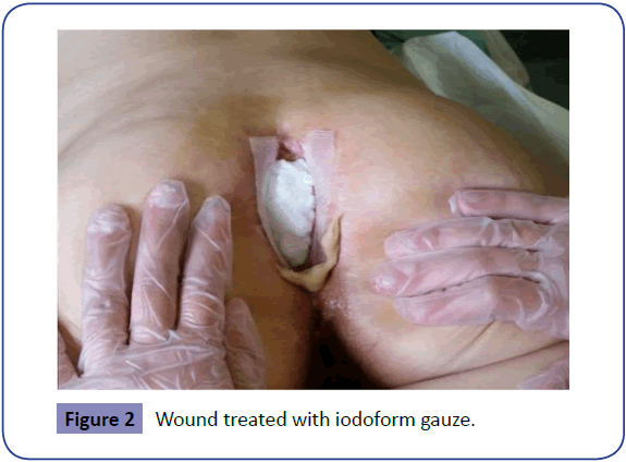 Colorectal-Cancer-Wound-treated-iodoform