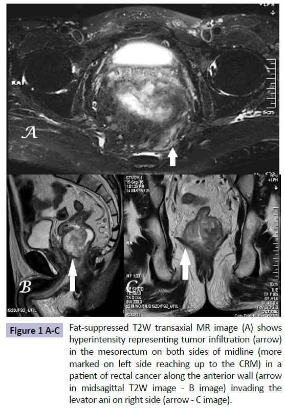 Colorectal-Cancer-hyperintensity-representing