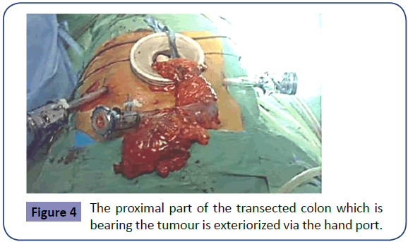Colorectal-Cancer-proximal-transected-tumour