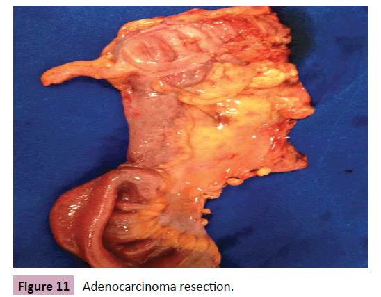 Colorectal-Cancer-resection
