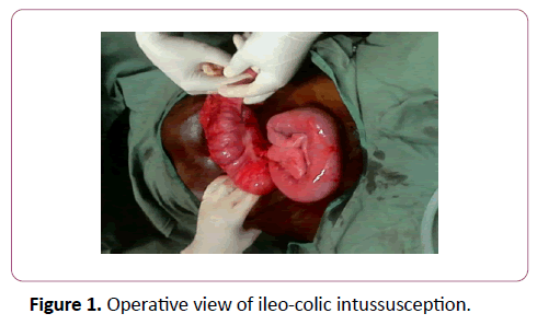 colorectal-cancer-Operative-view-ileo-colic-intussusception