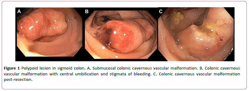 colorectal-cancer-Polypoid-lesion-sigmoid-colon