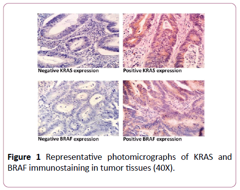 colorectal-cancer-photomicrographs