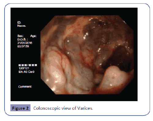 colorectal-cancer-view-Varices